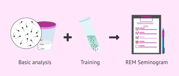 Semagogram REM semenogram after sperm capacitation
