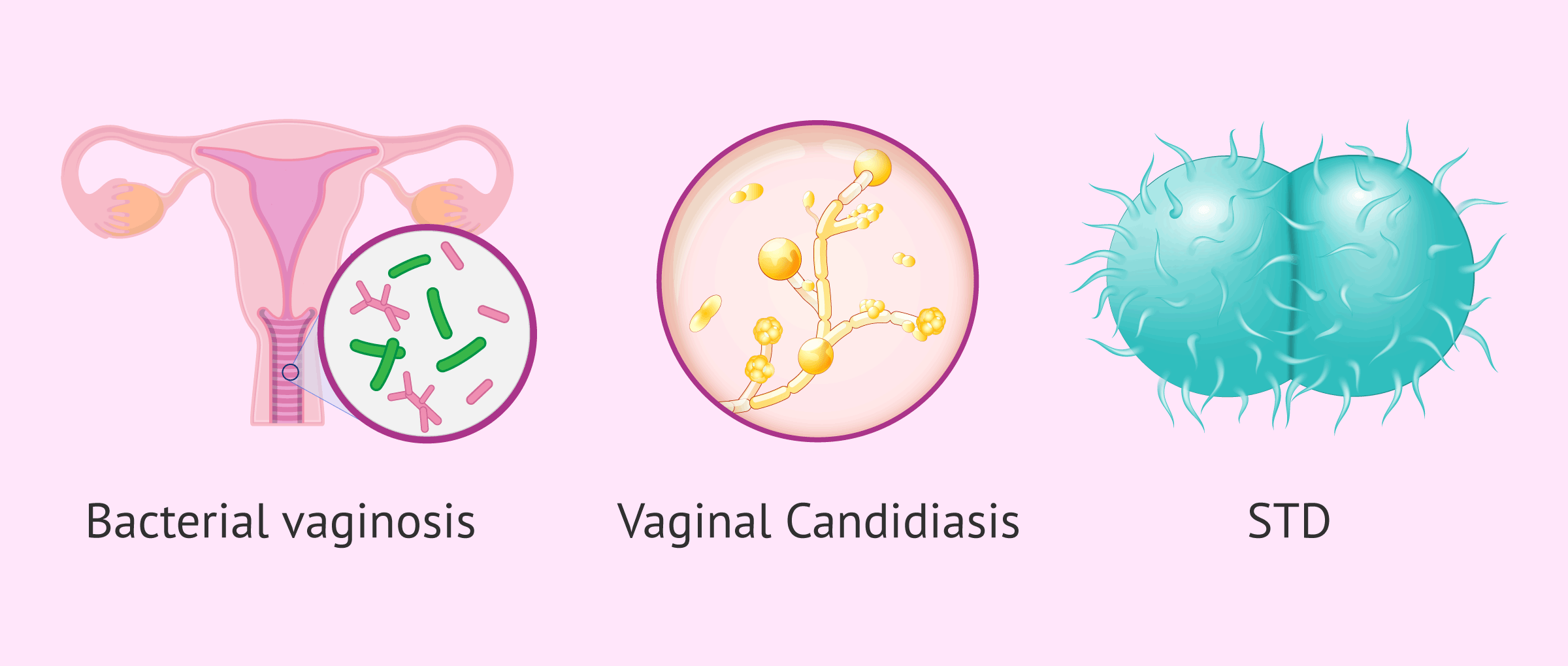 Possible causes of abnormal vaginal discharge