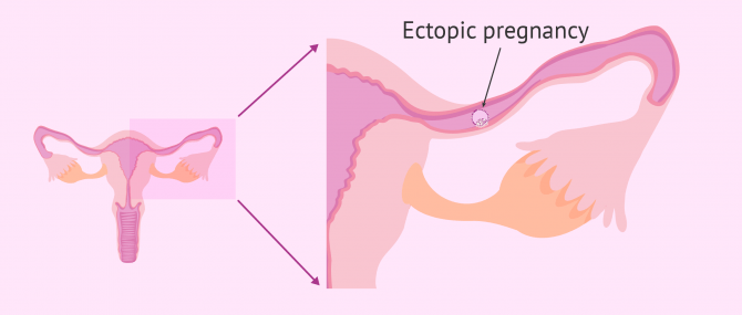 Imagen: Ectopic pregnancy