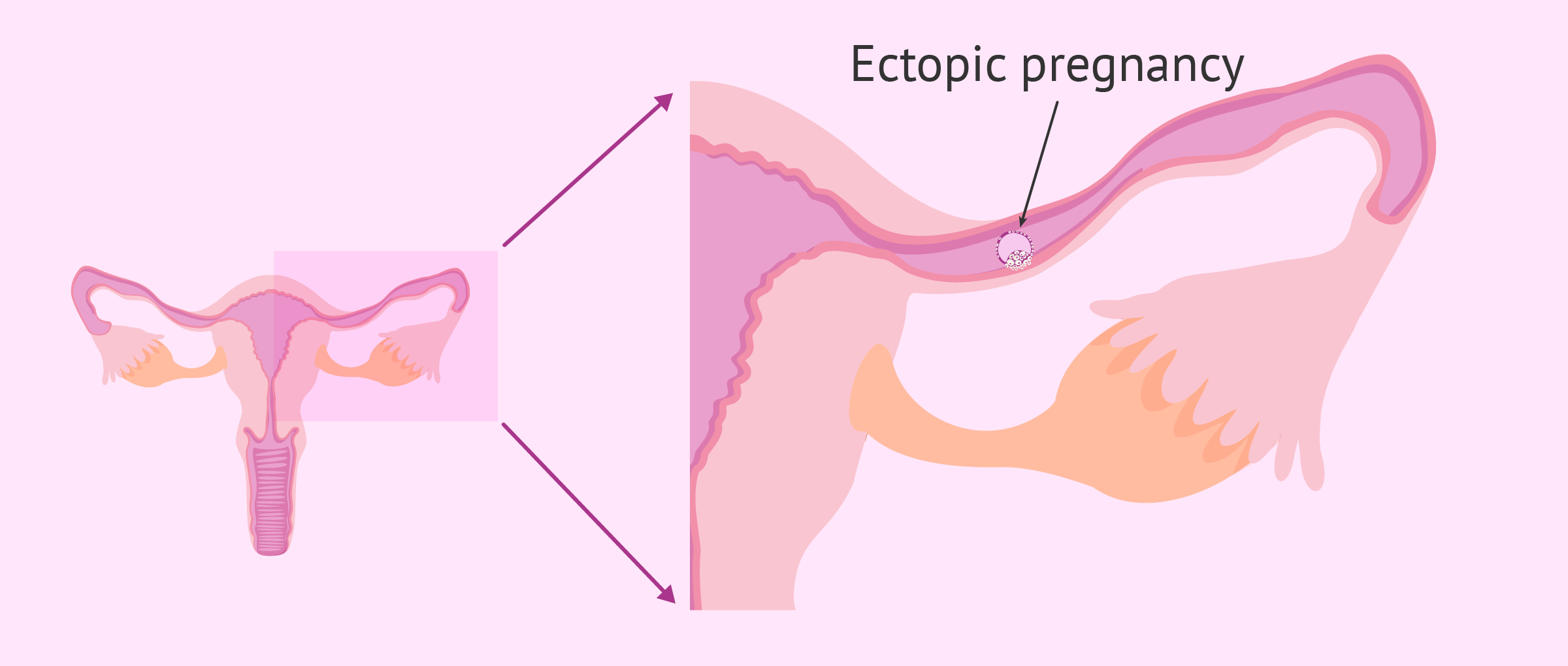 Ectopic pregnancy after intrauterine insemination