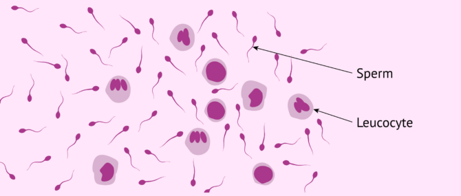 Imagen: Analysis of the amount of leukocytes in semen