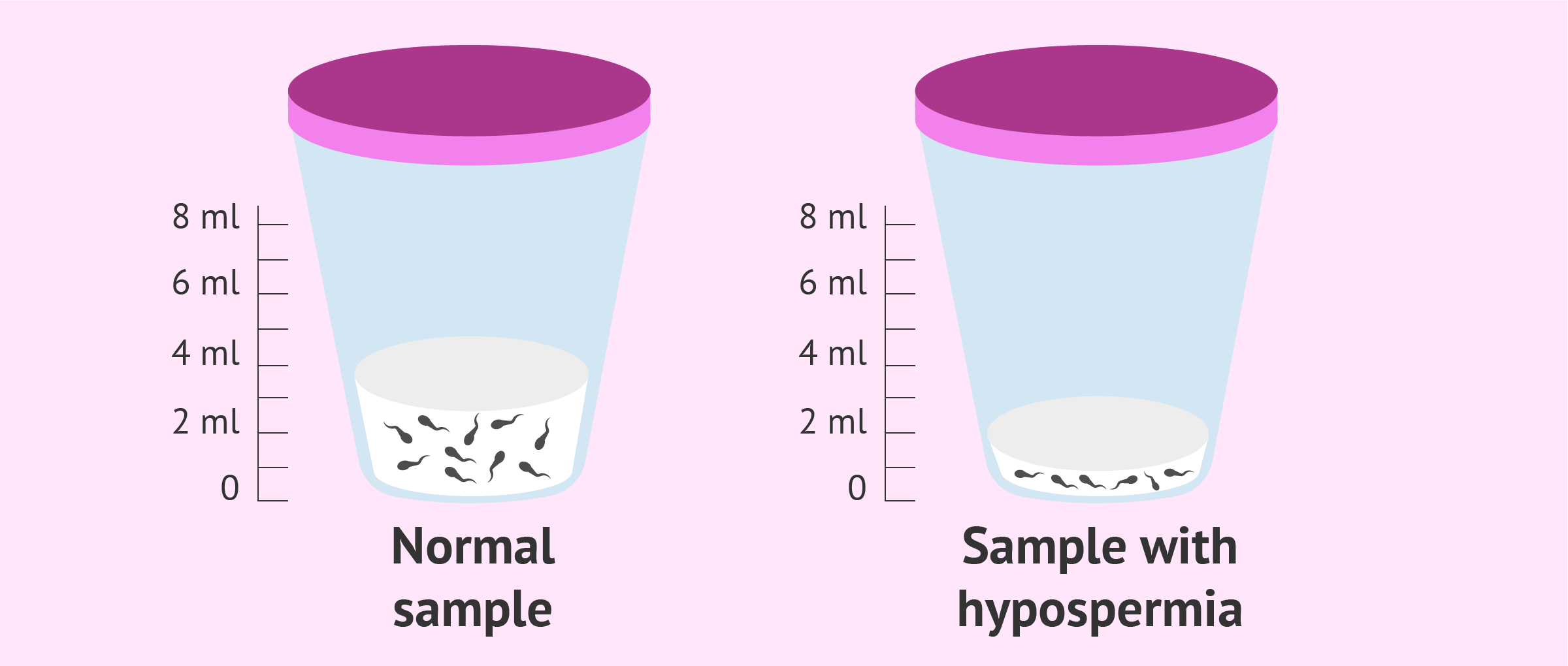 What Is Hypospermia? - Causes, Symptoms & Treatment