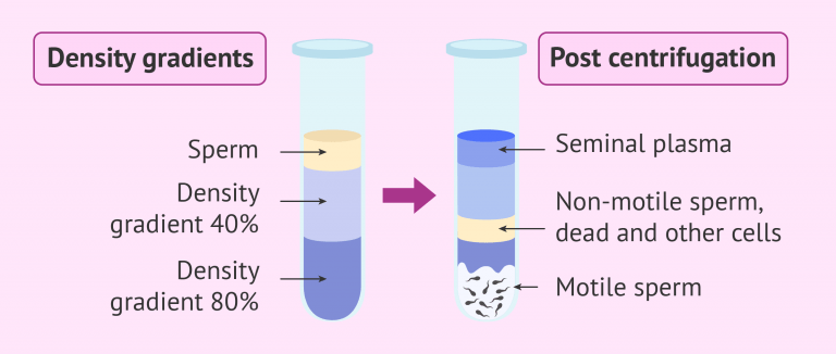 Density Gradient Column Method What is sperm cell capacitation? - definition and the in vitro techniques