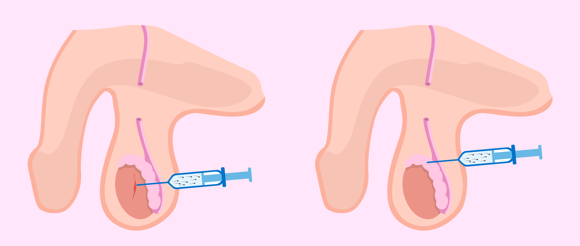 Epididymal and testicular sperm aspiration