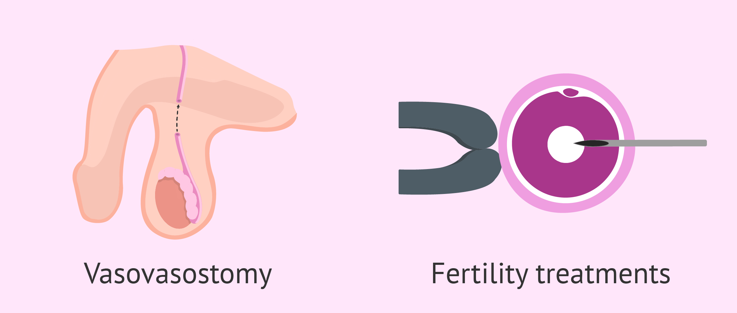 Can You Get Pregnant After a Vasectomy? - Your Realistic Possibility