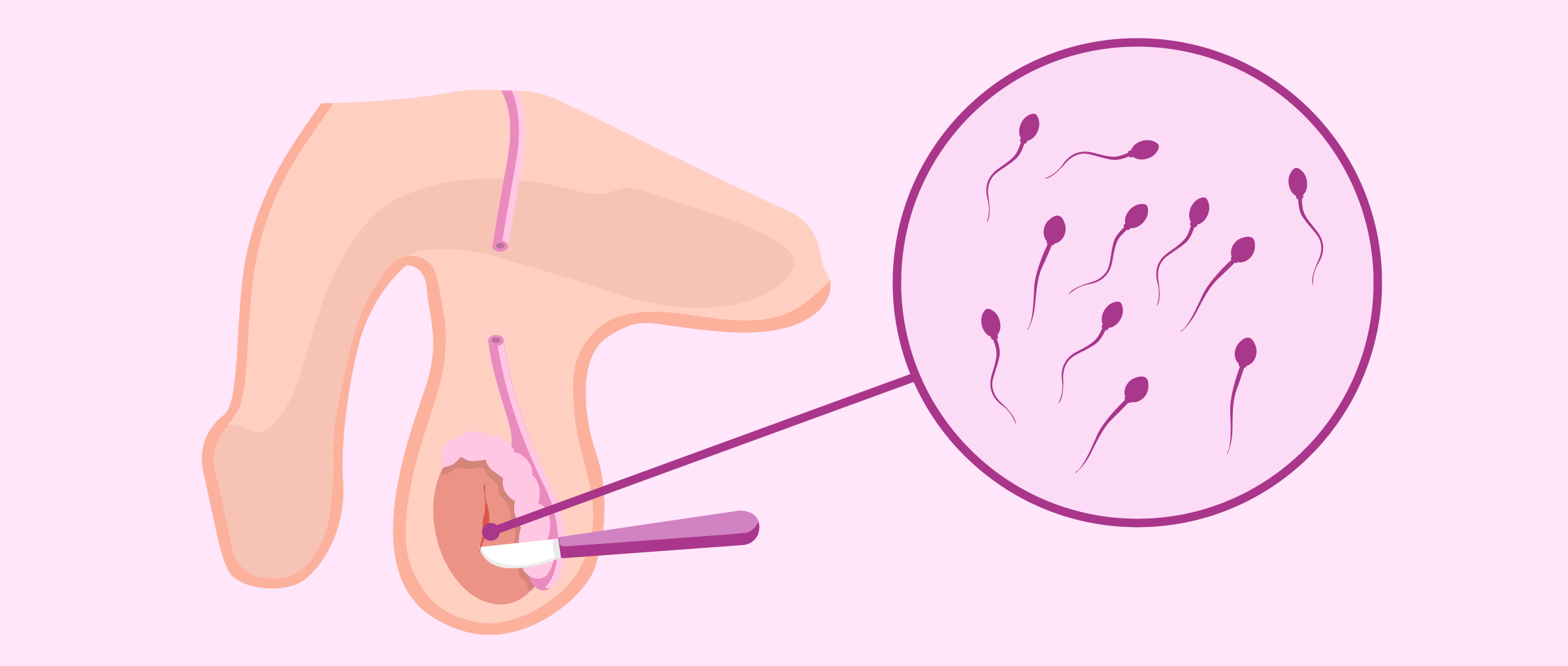 Testicular biopsy to collect sperm