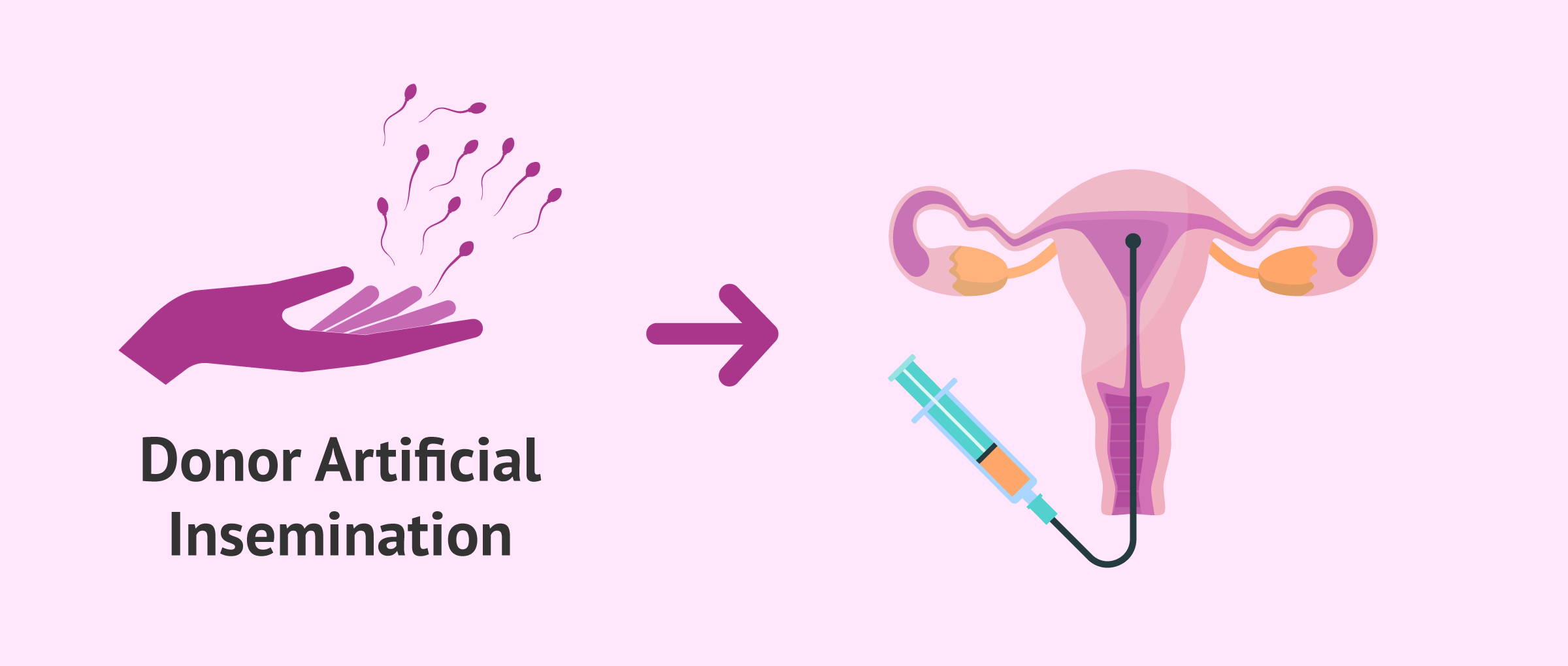 Artificial insemination with donor sperm