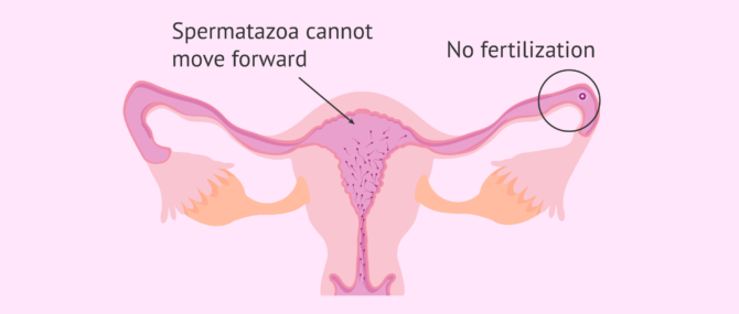 Imagen: The sperm cannot get to the egg
