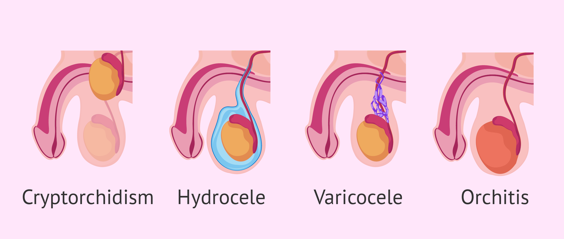 Testicular Causes for Male Infertility