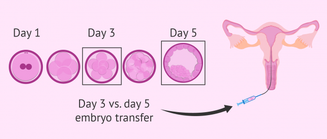 Embryo transfer on day 3 or 5?