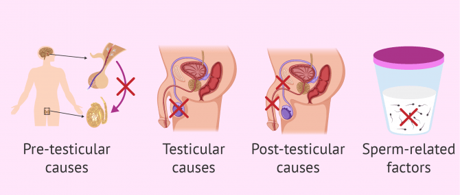 What Causes Male Infertility? – Symptoms & Treatment