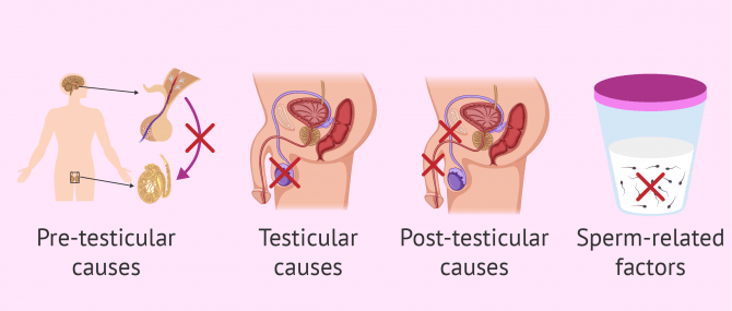 What are the causes of male infertility? – Symptoms & solutions