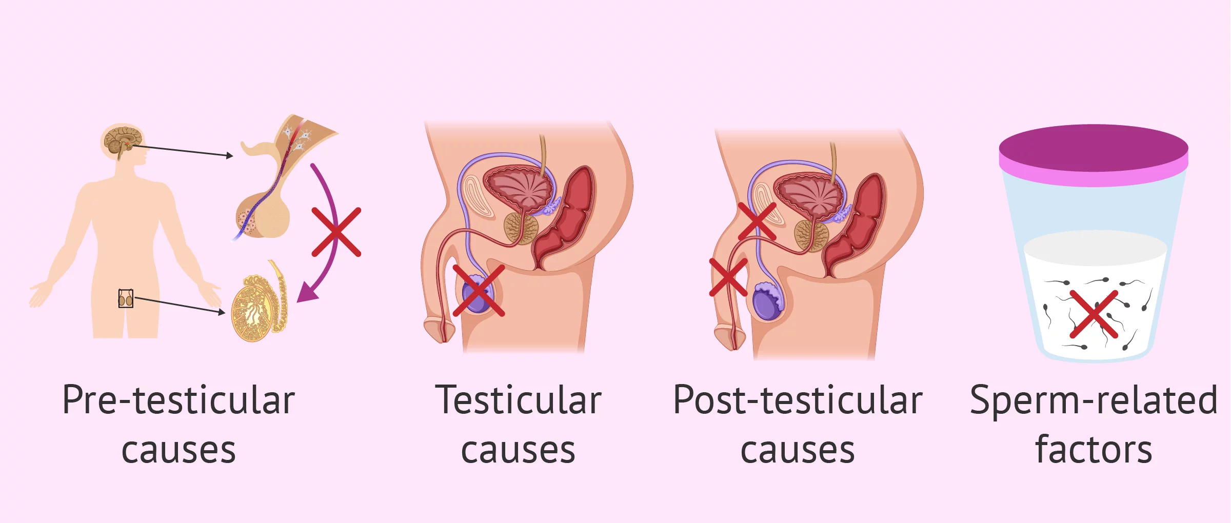 Male Infertility
