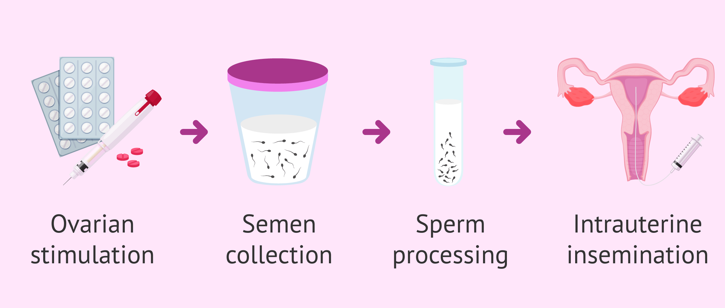 What is intrauterine insemination (IUI) with partners sperm? hq photo