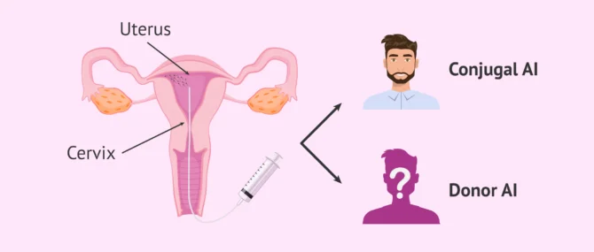 Imagen: Intrauterine artificial insemination procedure