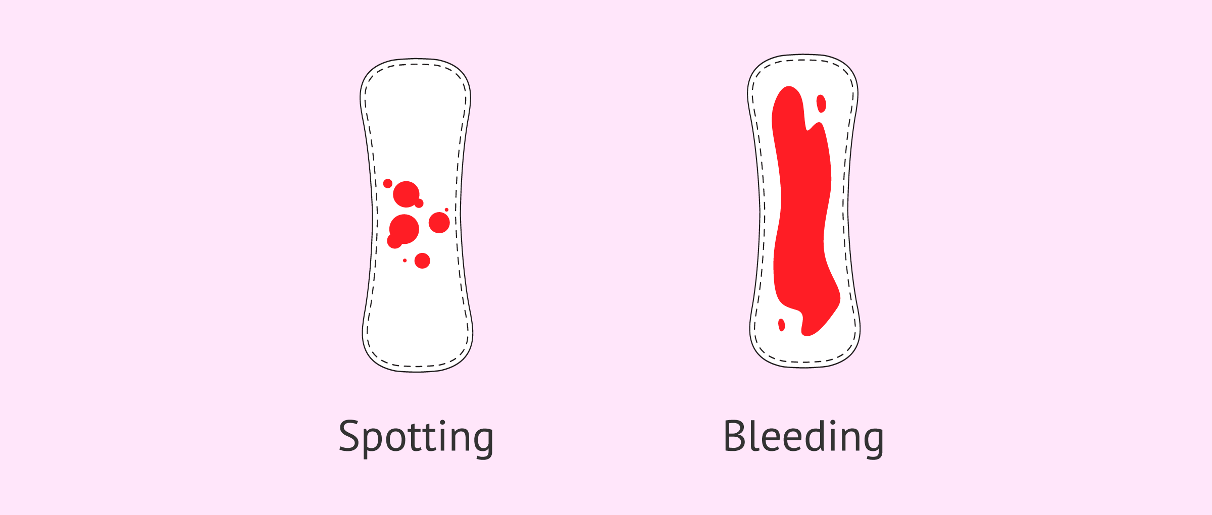 Imagen: Spotting or bleeding in pregnancy