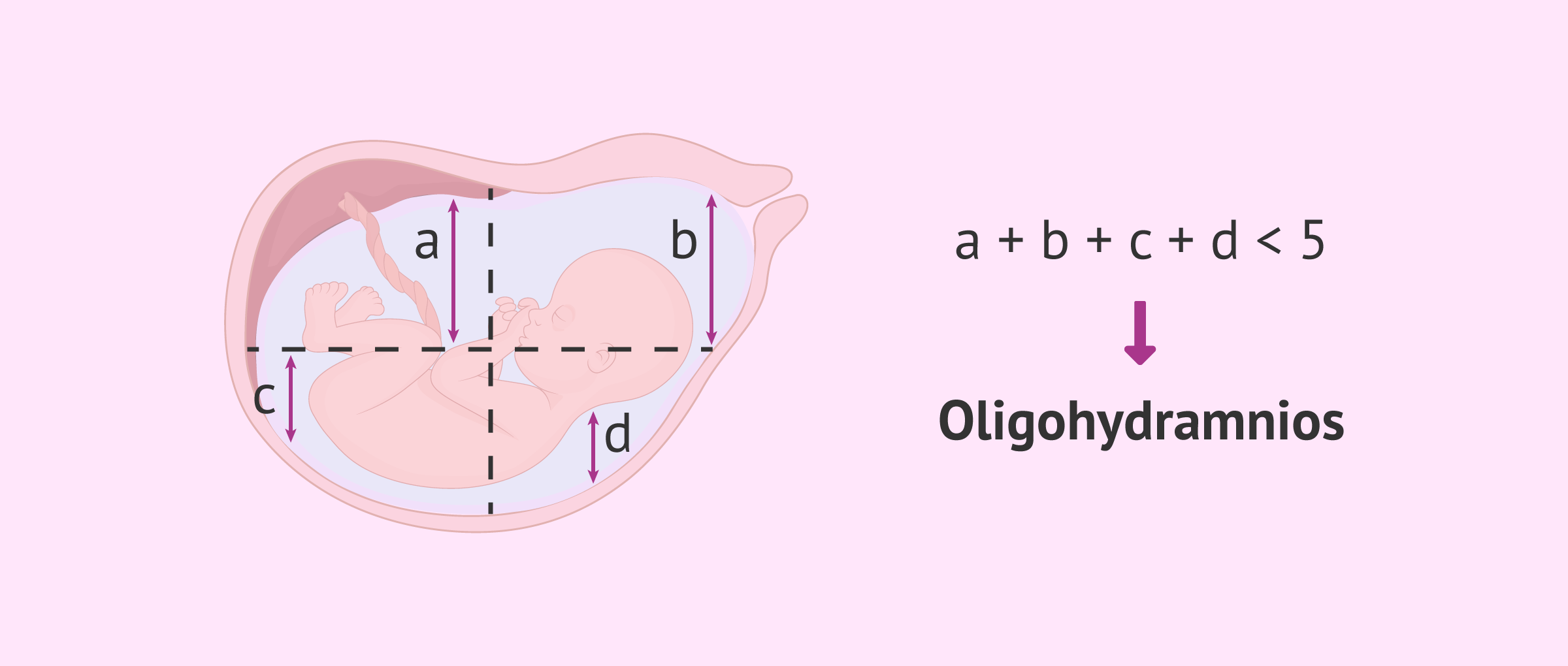 Imagen: Diagnosis of oligohydramnios