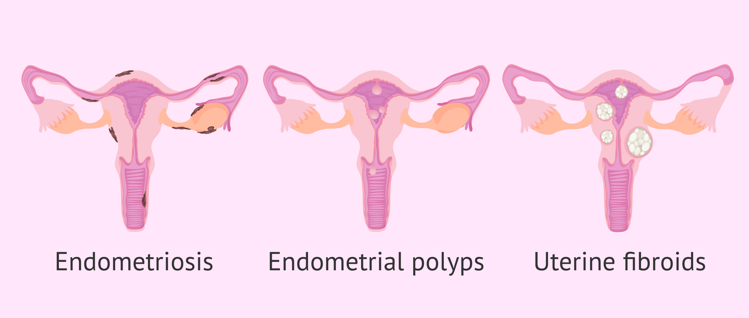 Pathologies affecting the endometrium