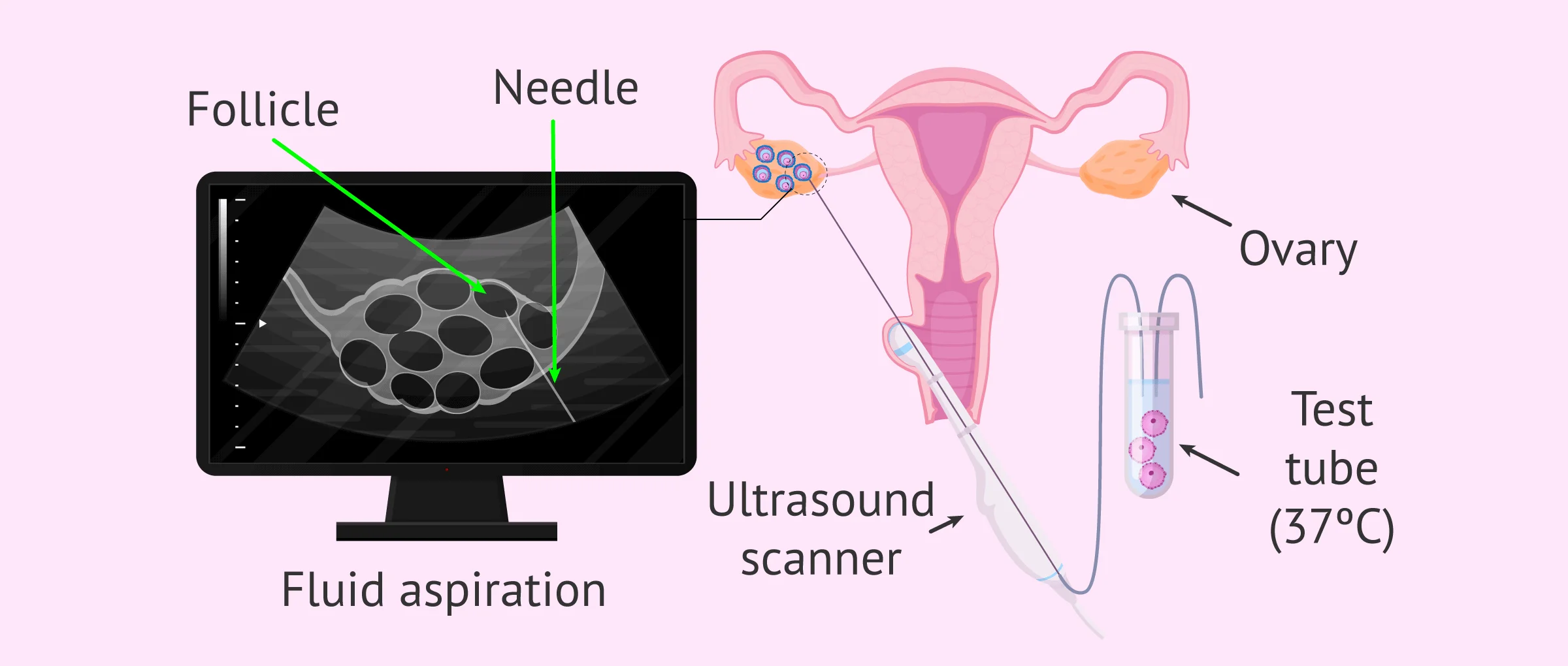Follicular aspiration or ovarian puncture