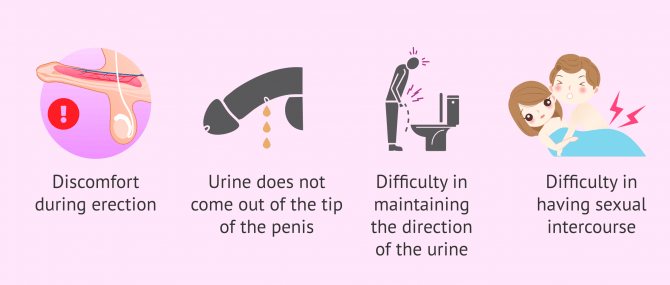 Imagen: Symptoms of hypospadias