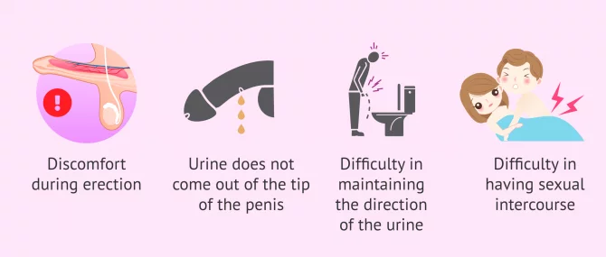 Imagen: Symptoms of hypospadias