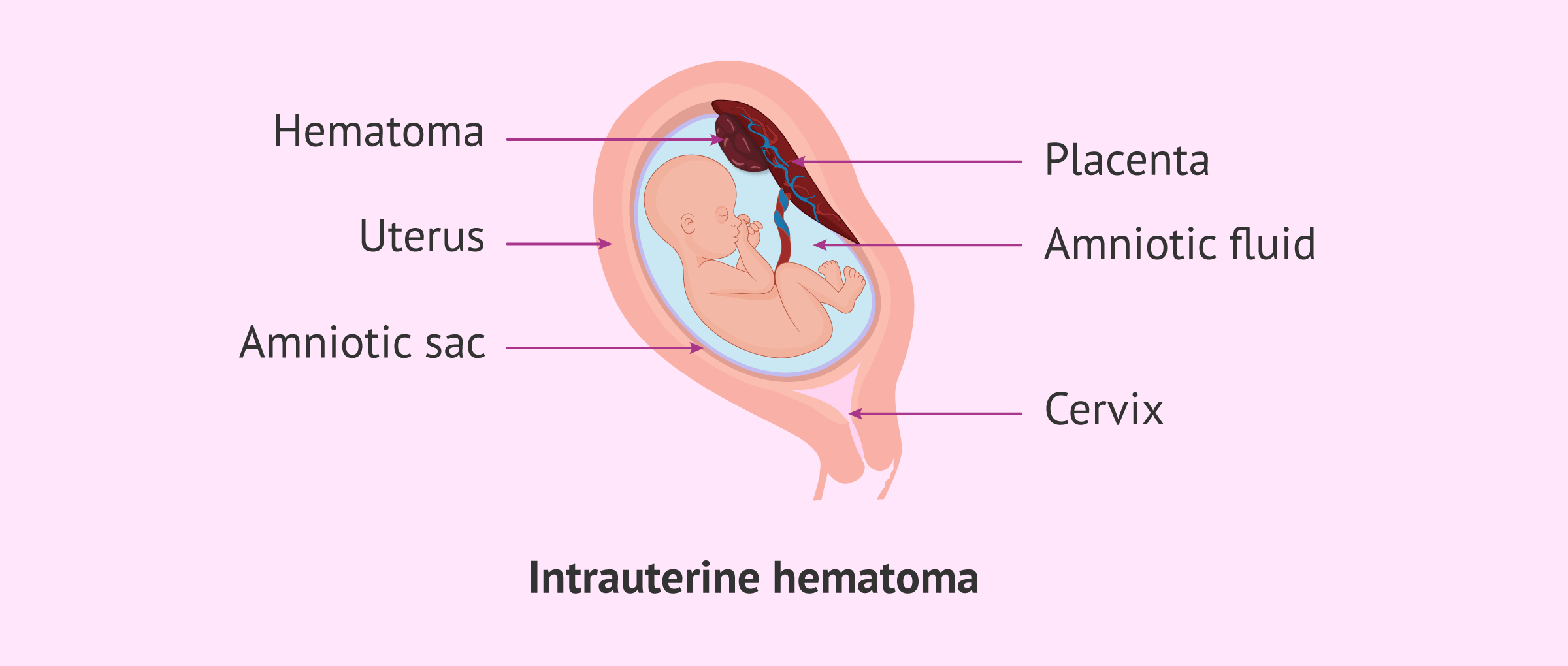Hematoma inside the uterus during pregnancy