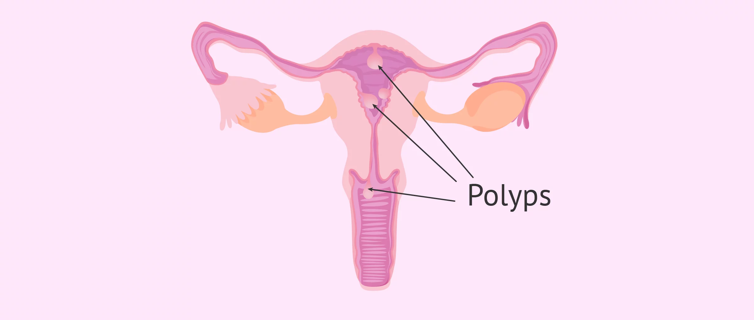 Endometrial Polyps