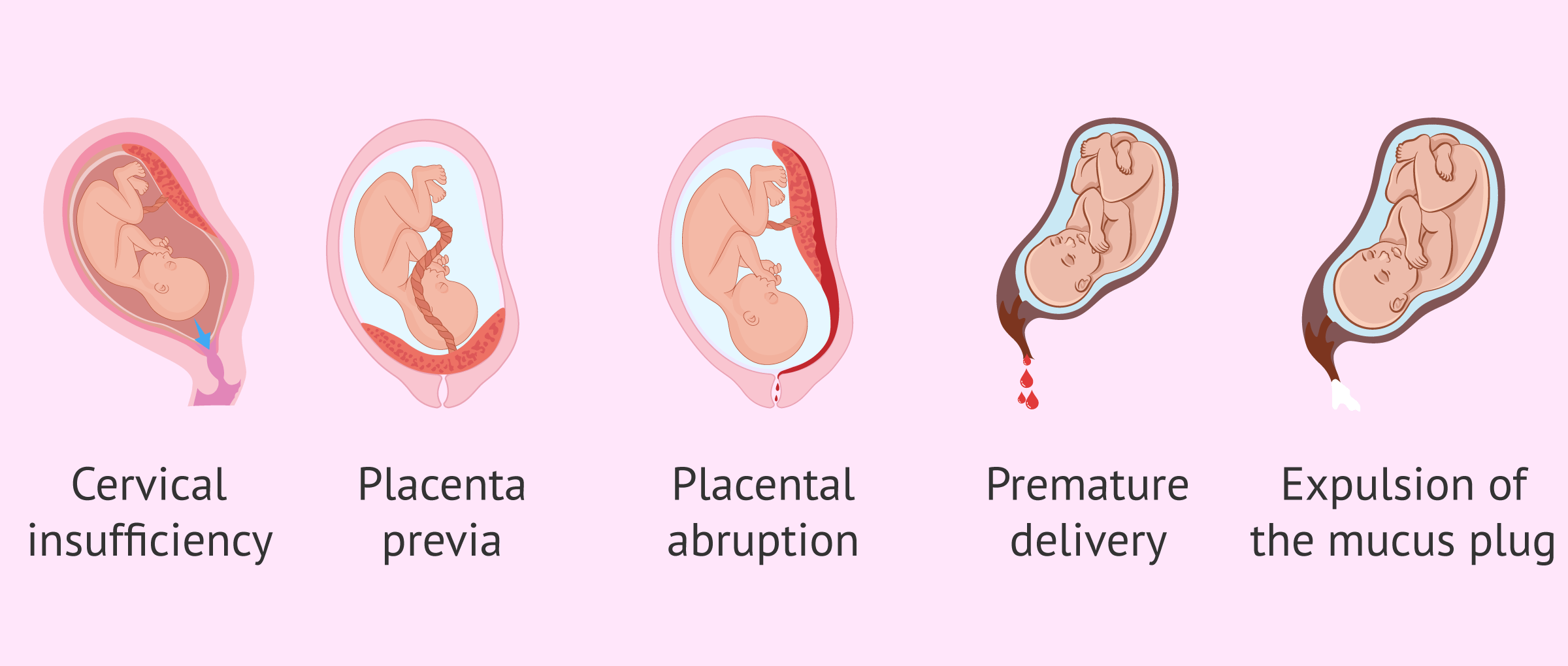 Causes Of Bleeding In The Second And Third Trimester Of Pregnancy