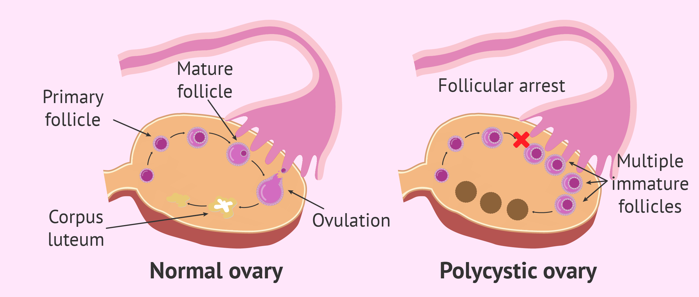 Normal ovary vs. polycystic ovary