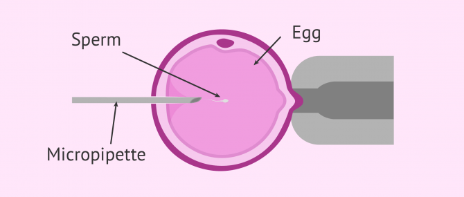 Intracytoplasmic sperm injection: What is ICSI and how much is it?