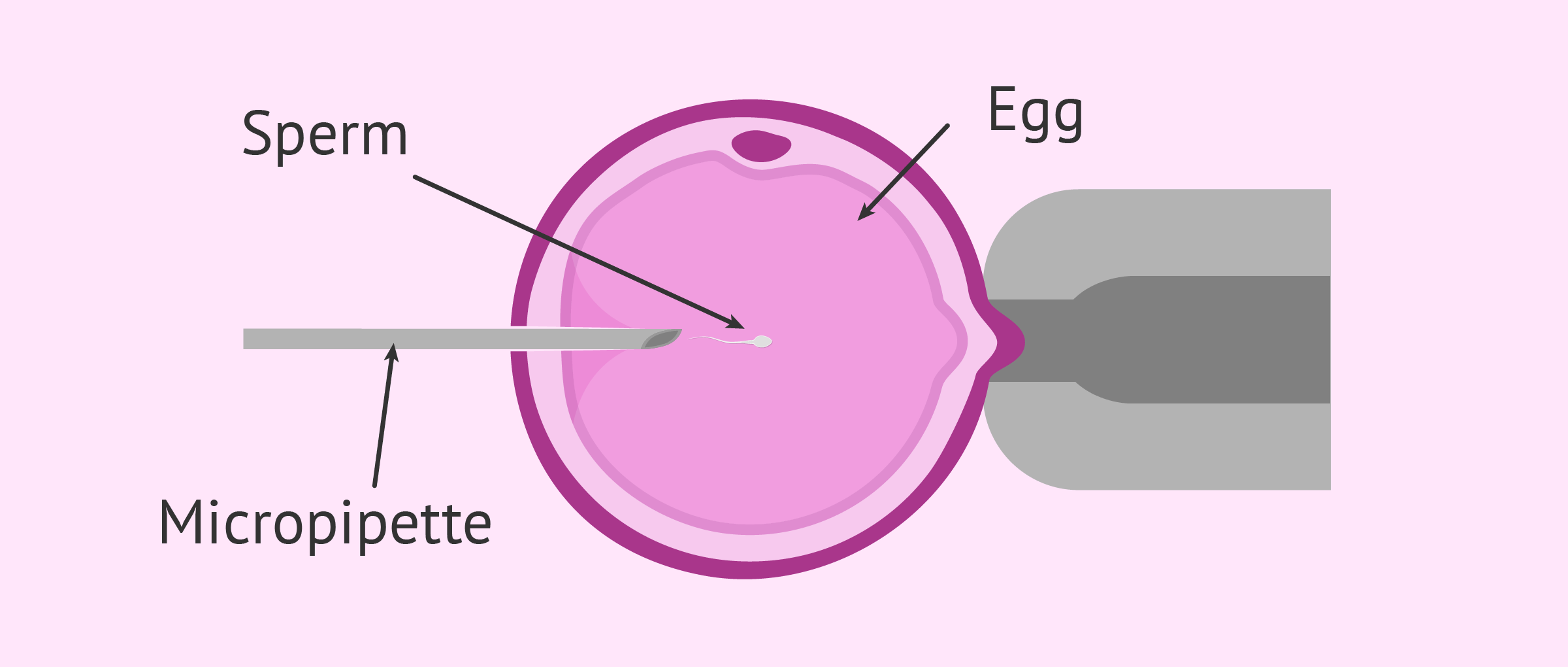 Intracytoplasmic Sperm Injection (ICSI)