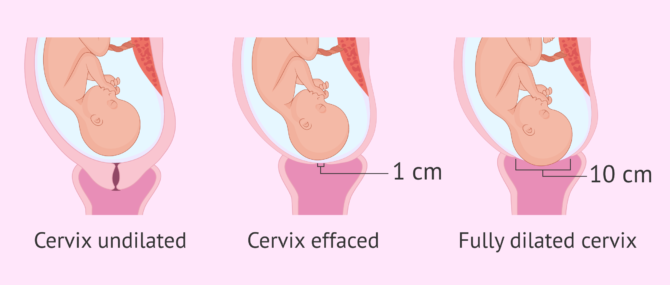 Imagen: Cervical effacement and dilatation in childbirth