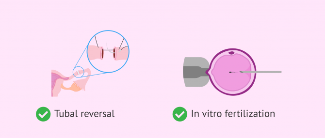 Imagen: Pregnancy options after tubal ligation