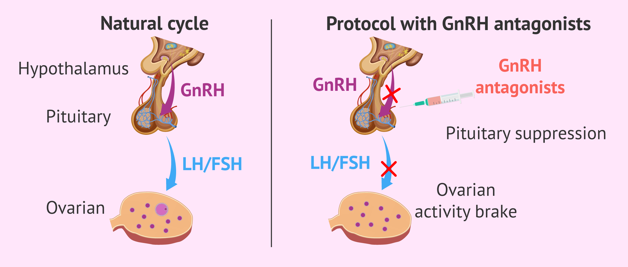Mechanism of action of GnRH antagonists