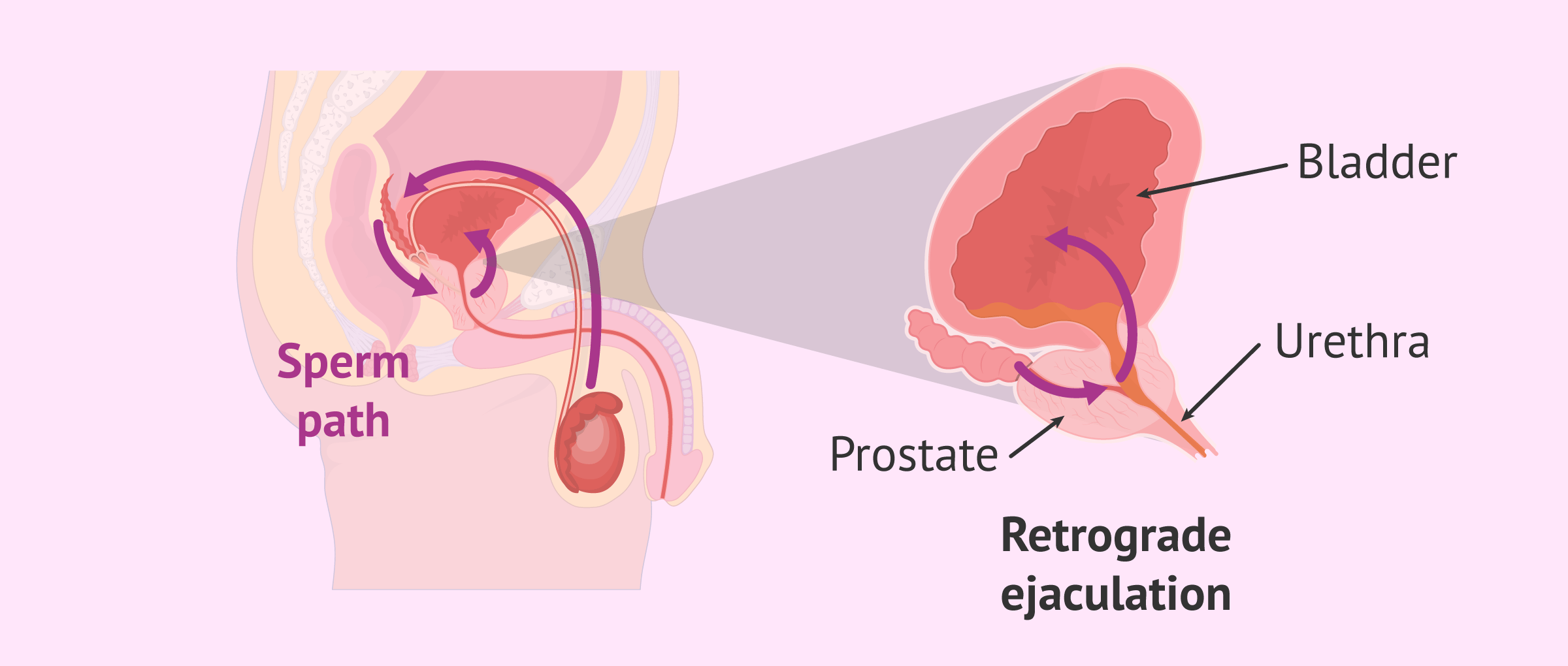 What does retrograde ejaculation look like?