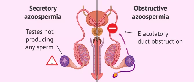 Types of azoospermia