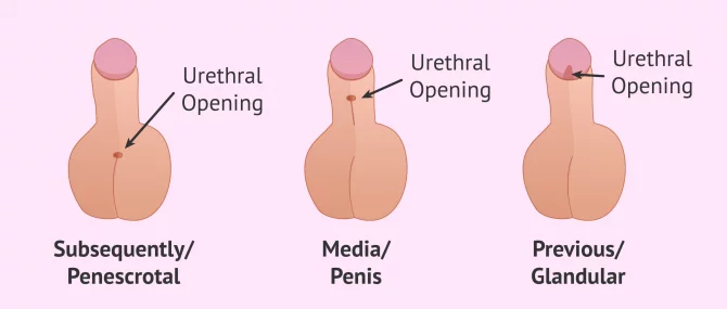 Imagen: How can hypospadias be?
