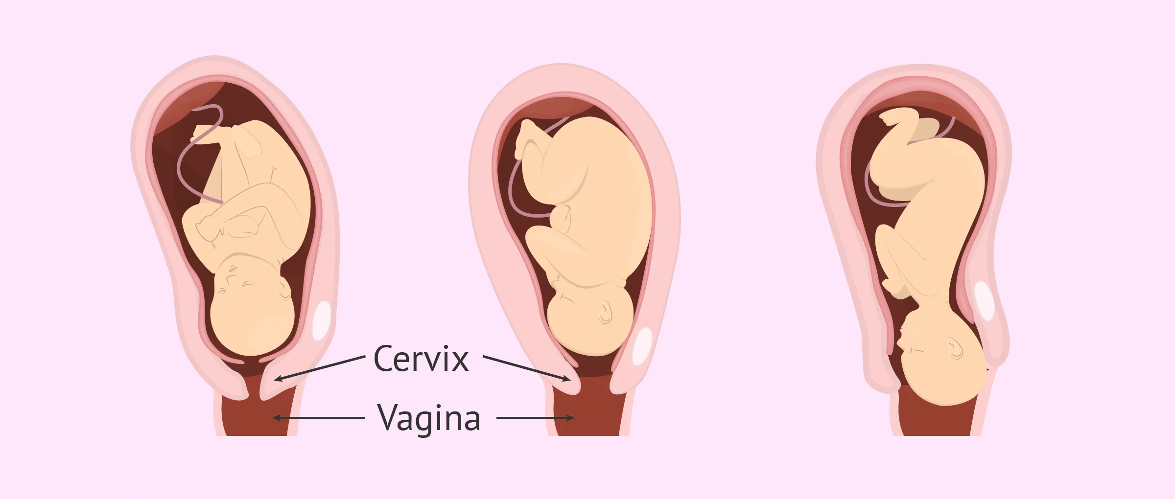 Imagen: Vaginal delivery