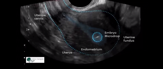 Embryo drop in uterine fundus