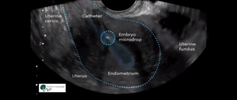 Embryo transfer sonography
