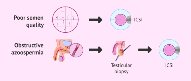 Indications for ICSI for male cause