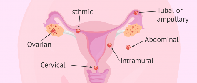 Labelled diagram of the different types of ectopic pregnancy