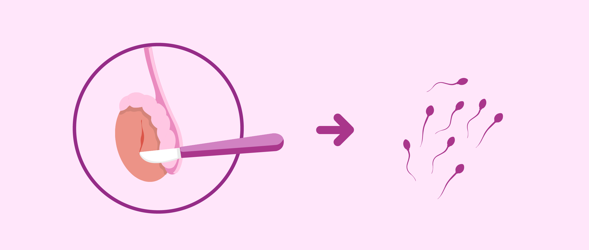 Testicular biopsy to retrieve sperm
