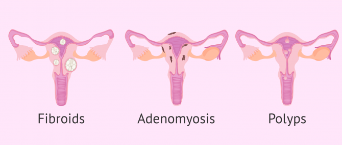 Illustration of Hysterectomy Genetic Testing For Women
