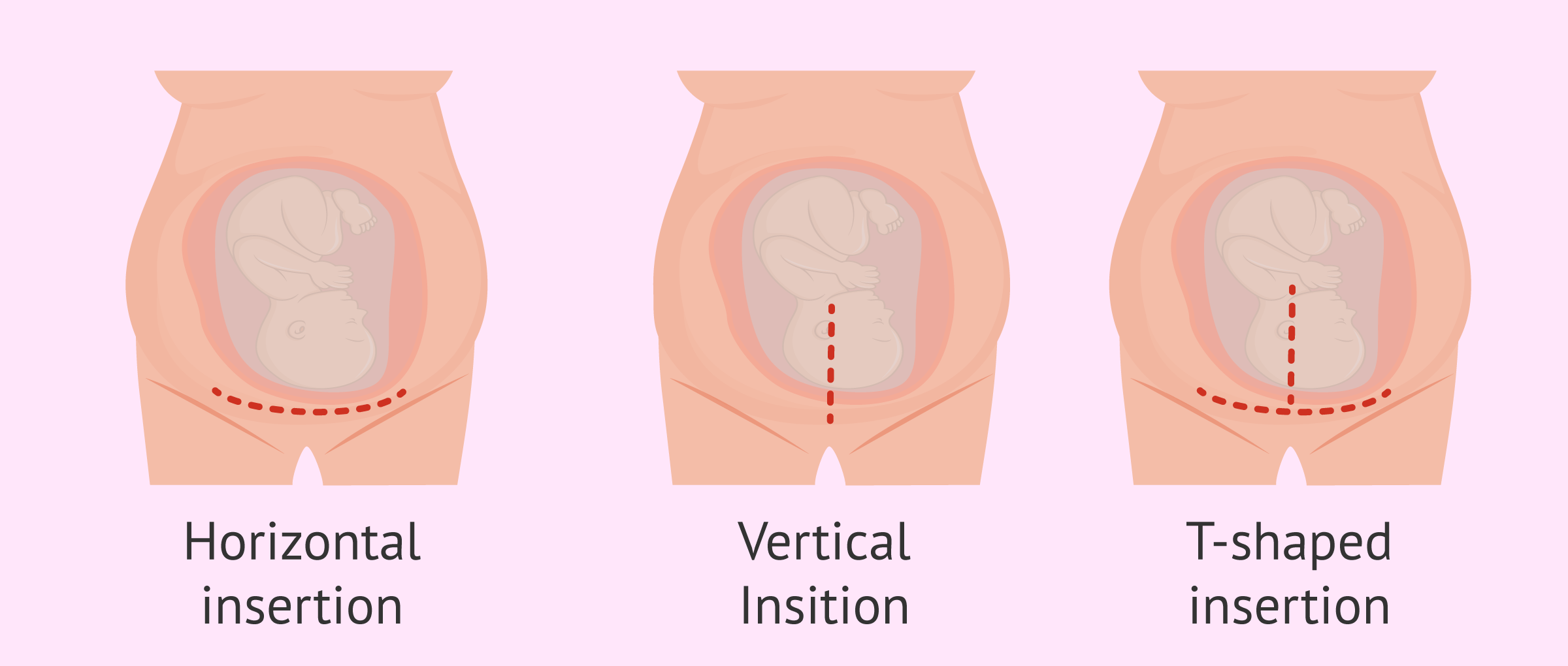 compound presentation cesarean section