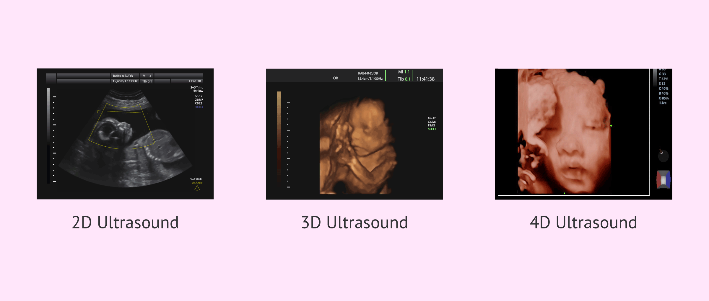 Differences in imaging between 2D, 3D and 4D ultrasound