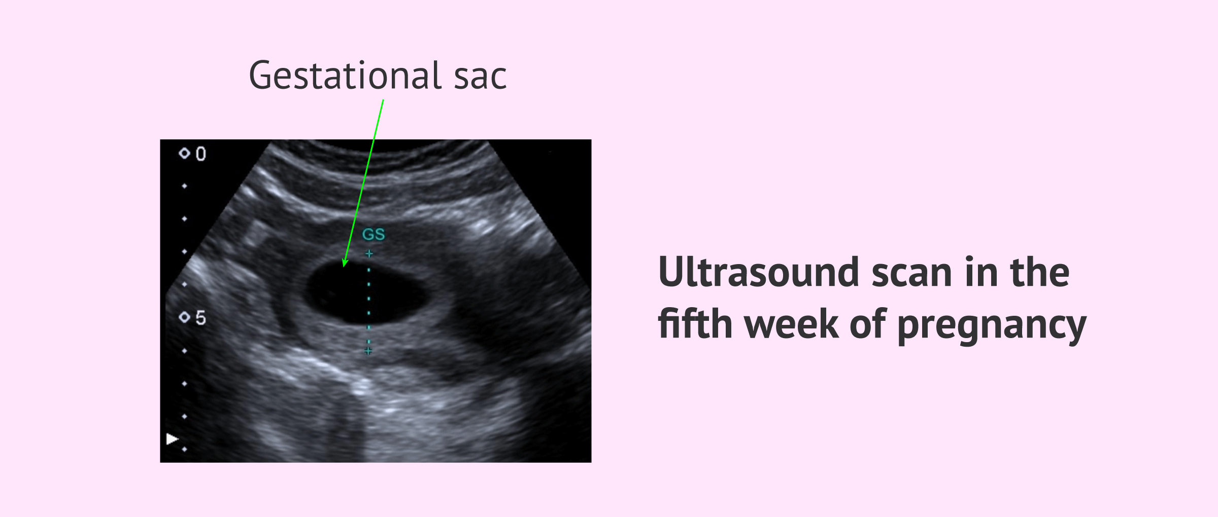Five Weeks Pregnant Development Of The Baby And Symptoms Of Mother Five Weeks Pregnant Development Of The Baby And Symptoms Of Mother