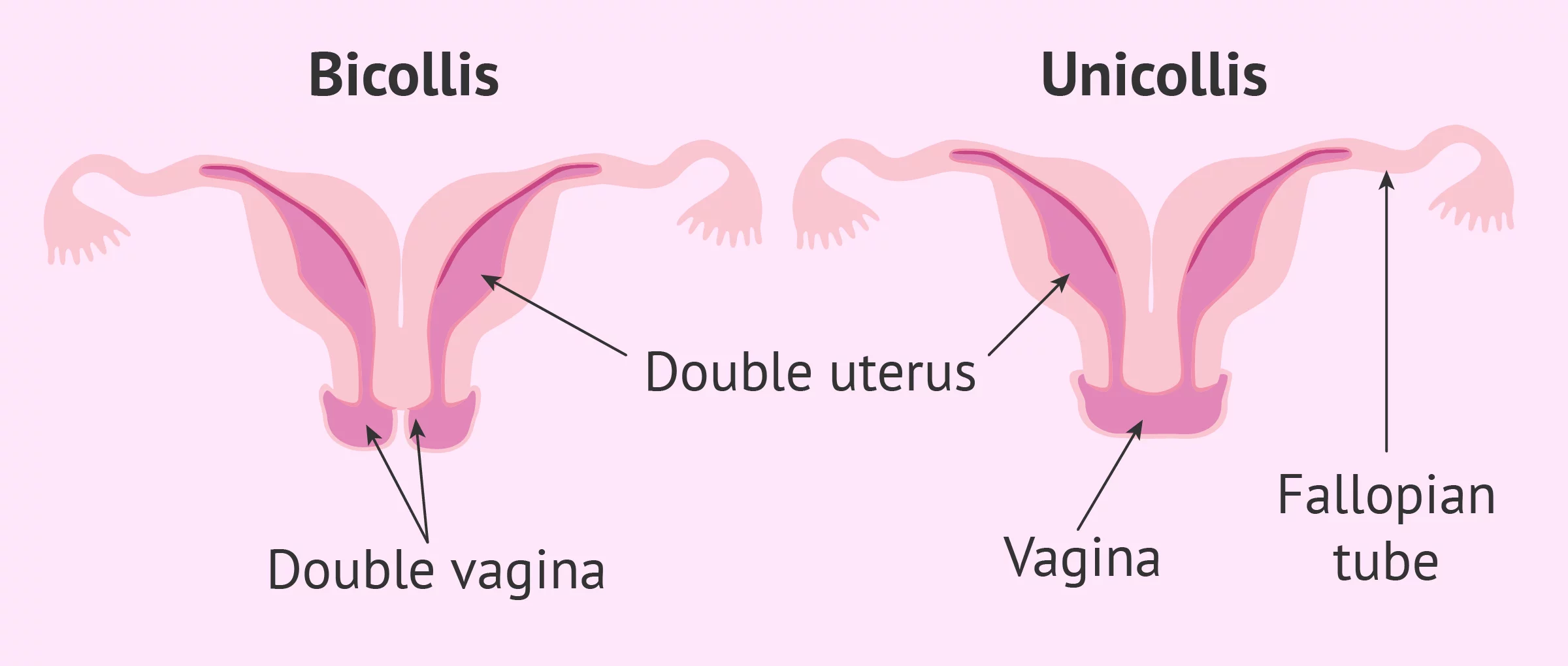 Types of uterine didelphys