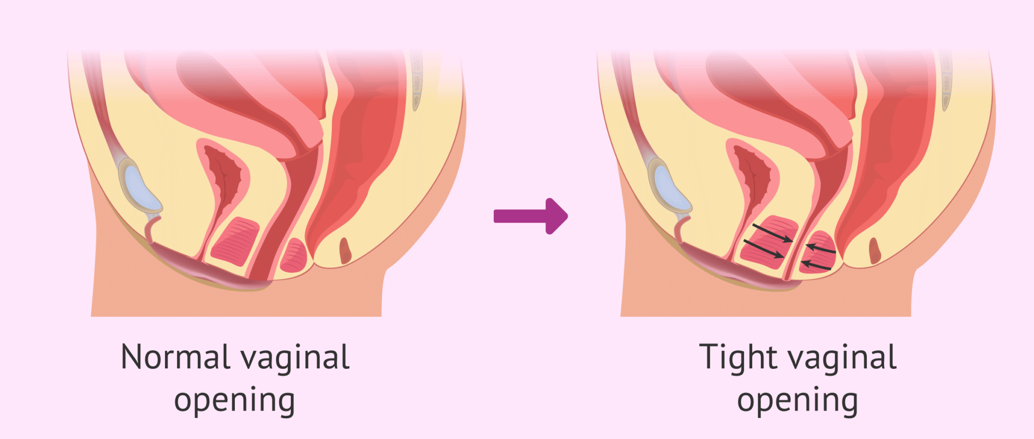 Why does pain during sexual intercourse, or dyspareunia, occur?