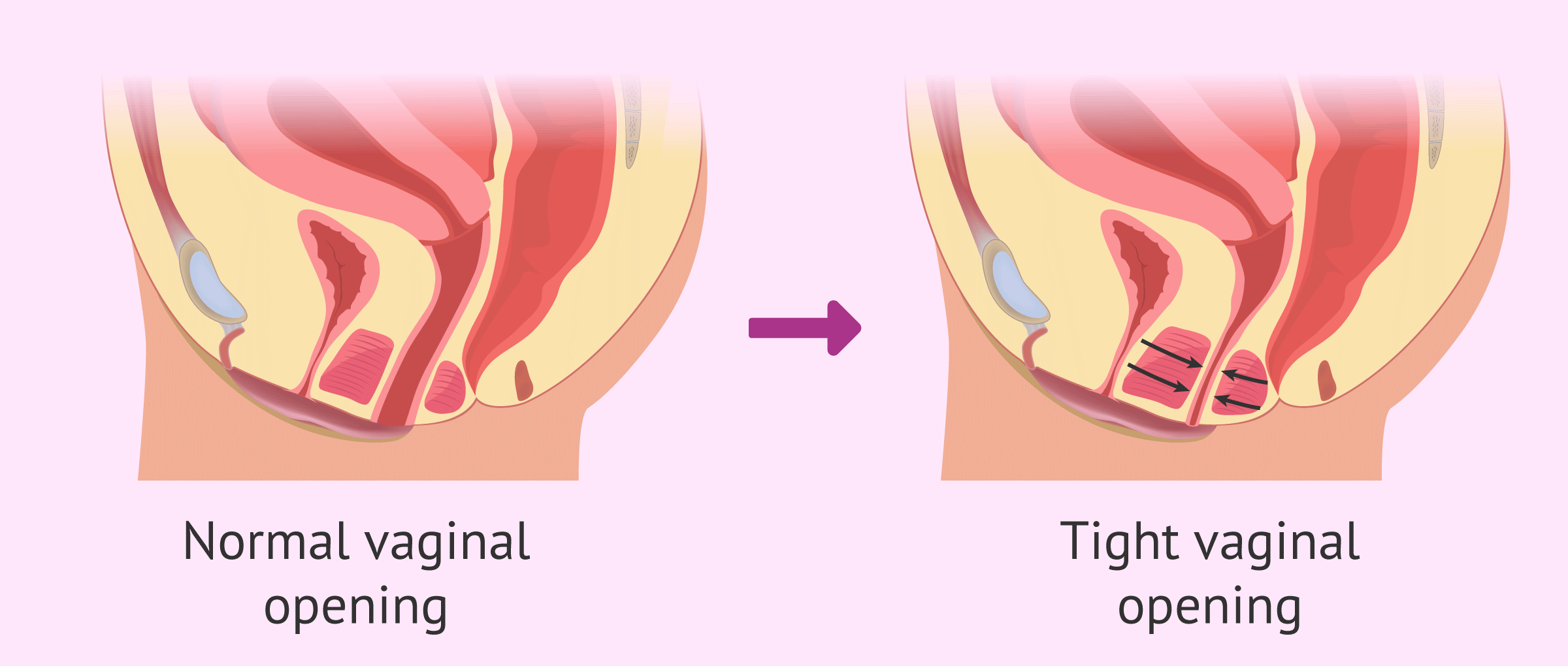 Vaginismus